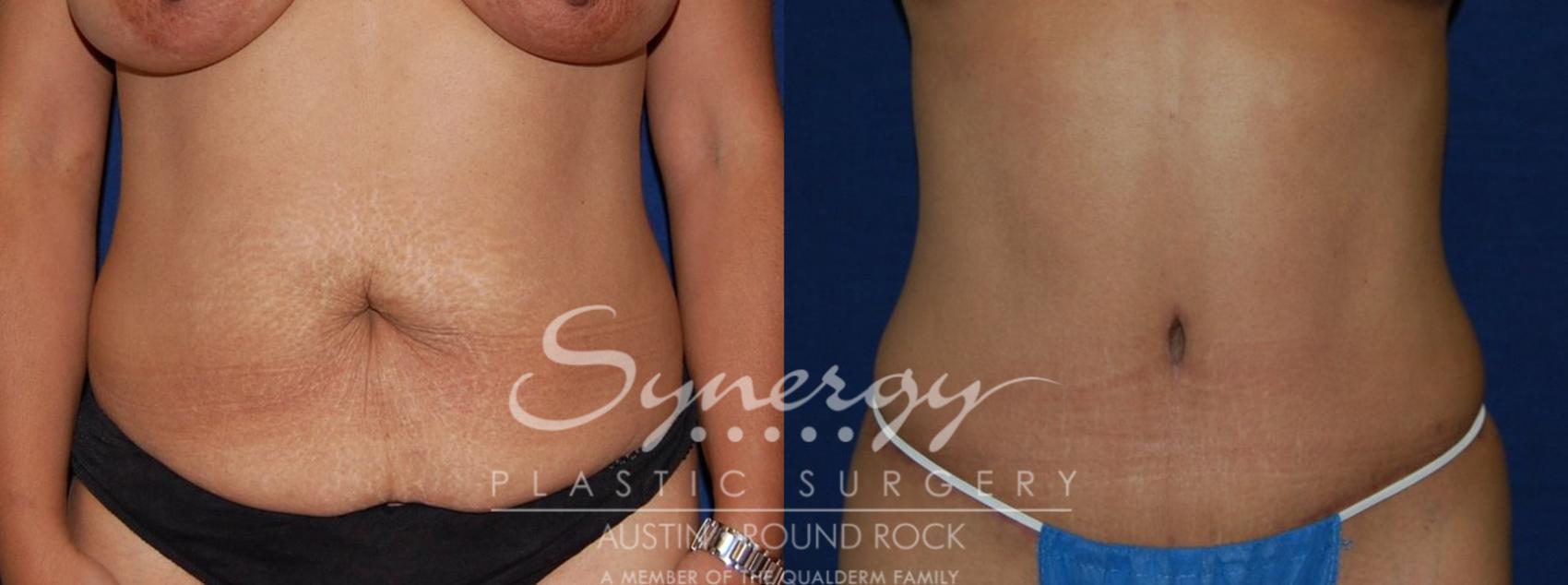 Before & After Abdominoplasty (Tummy Tuck) Case 112 View #1 View in Austin, TX