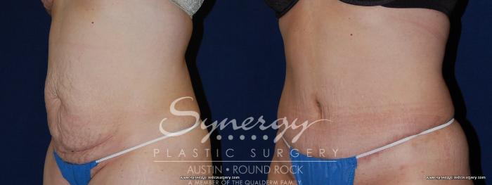 Before & After Abdominoplasty (Tummy Tuck) Case 149 View #1 View in Austin, TX