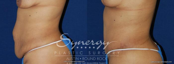 Before & After Abdominoplasty (Tummy Tuck) Case 156 View #1 View in Austin, TX