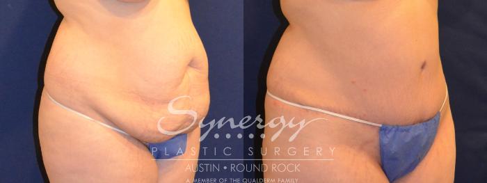 Before & After Abdominoplasty (Tummy Tuck) Case 292 View #2 View in Austin, TX