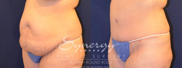 Before & After Abdominoplasty (Tummy Tuck) Case 292 View #4 View in Austin, TX
