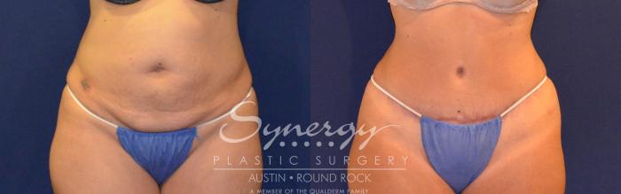 Before & After Abdominoplasty (Tummy Tuck) Case 308 View #1 View in Austin, TX