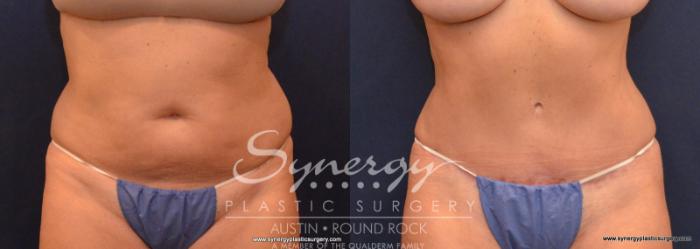 Before & After Abdominoplasty (Tummy Tuck) Case 576 View #1 View in Austin, TX