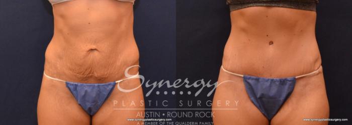 Before & After Abdominoplasty (Tummy Tuck) Case 617 View #1 View in Austin, TX