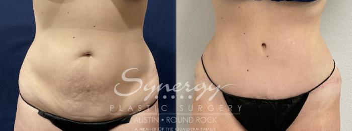 Before & After Abdominoplasty (Tummy Tuck) Case 871 Front View in Austin, TX