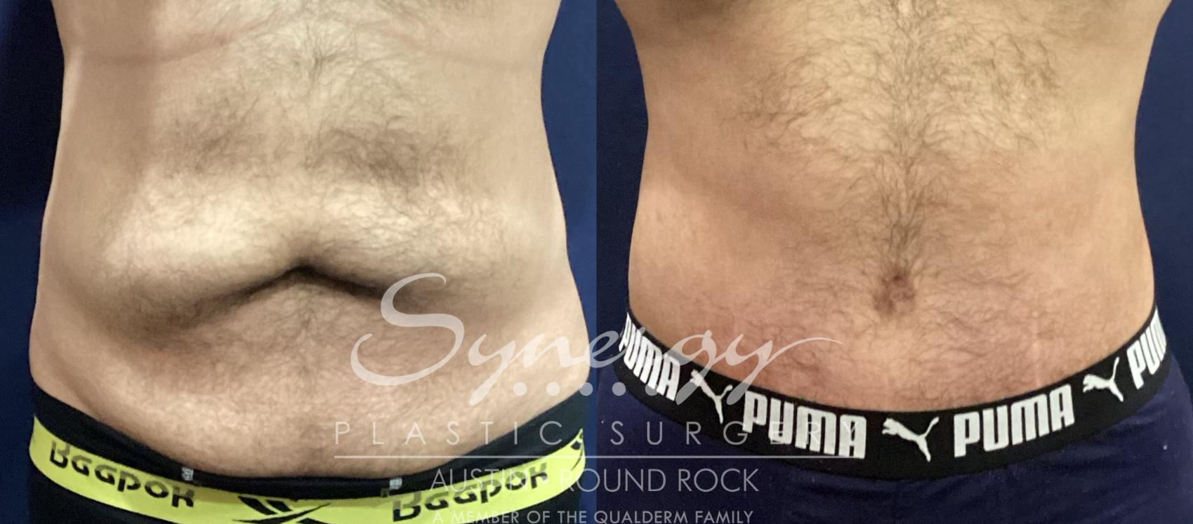 Before & After Abdominoplasty (Tummy Tuck) Case 938 Front View in Austin, TX
