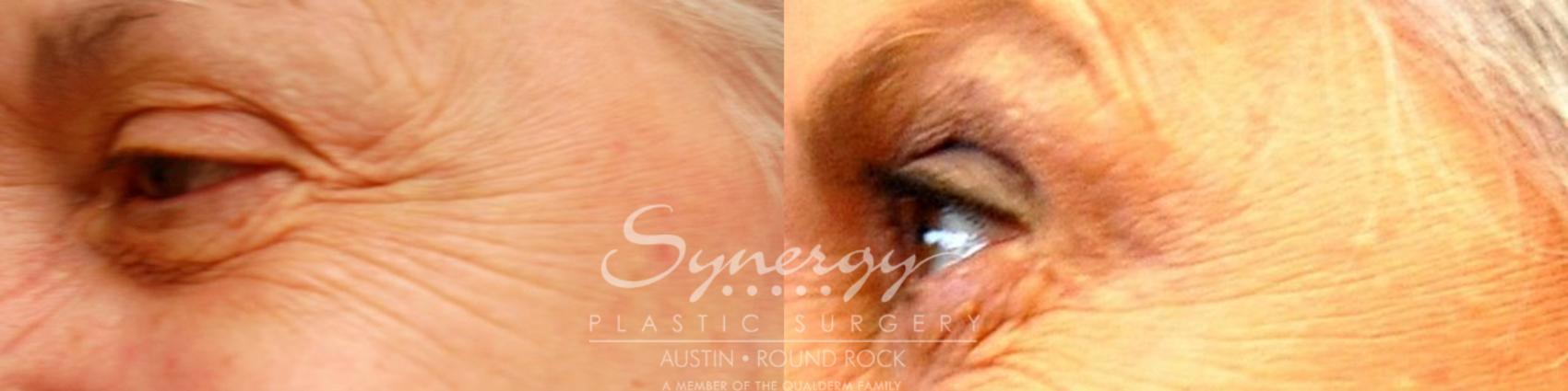 Before & After BOTOX® Cosmetic & Dysport® Case 22 View #1 View in Austin, TX
