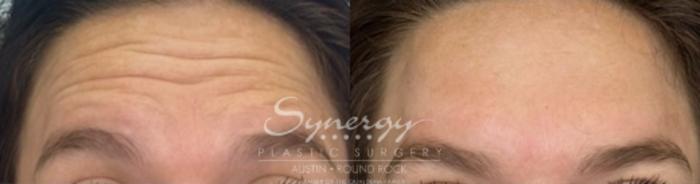 Before & After BOTOX® Cosmetic & Dysport® Case 844 Front View in Austin, TX
