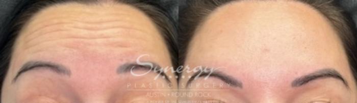 Before & After BOTOX® Cosmetic & Dysport® Case 845 Front View in Austin, TX