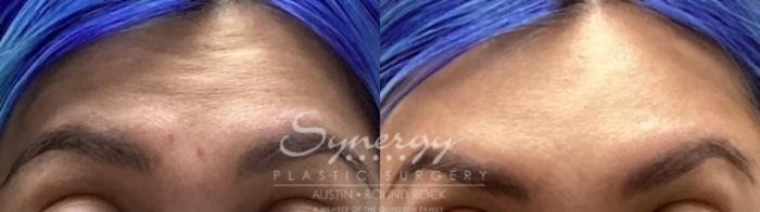 Before & After BOTOX® Cosmetic & Dysport® Case 850 Front View in Austin, TX