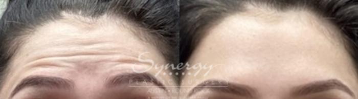 Before & After BOTOX® Cosmetic & Dysport® Case 851 Front View in Austin, TX