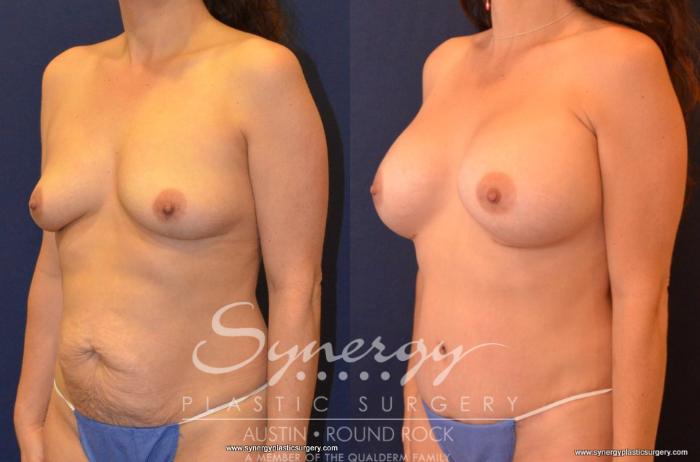Before & After Breast Augmentation Case 428 View #1 View in Austin, TX