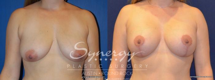 Before & After Breast Lift & Breast Augmentation Case 274 View #1 View in Austin, TX