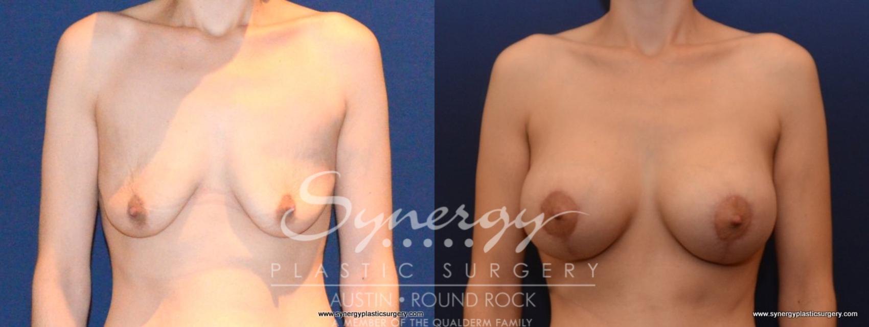 Before & After Breast Lift & Breast Augmentation Case 454 View #1 View in Austin, TX