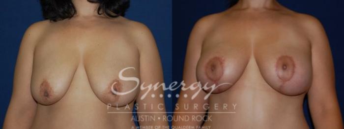 Before & After Breast Lift & Breast Augmentation Case 58 View #2 View in Austin, TX