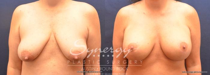 Before & After Breast Lift & Breast Augmentation Case 739 View #1 View in Austin, TX