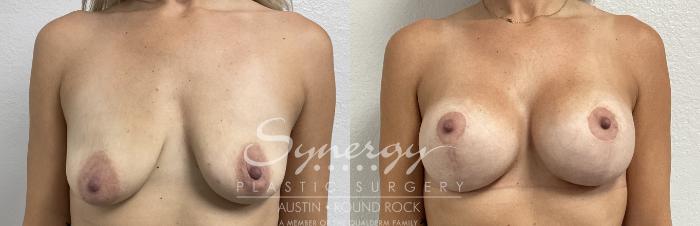 Before & After Breast Lift & Breast Augmentation Case 861 Front View in Austin, TX