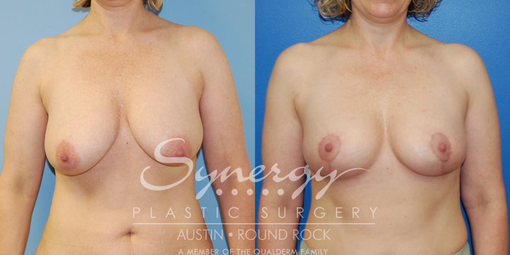 Before & After Breast Lift (Mastopexy) Case 39 View #1 View in Austin, TX