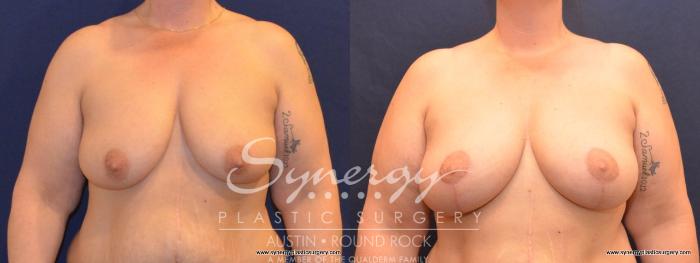 Before & After Breast Lift (Mastopexy) Case 412 View #1 View in Austin, TX