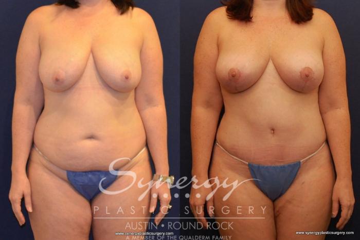 Before & After Breast Lift (Mastopexy) Case 434 View #1 View in Austin, TX