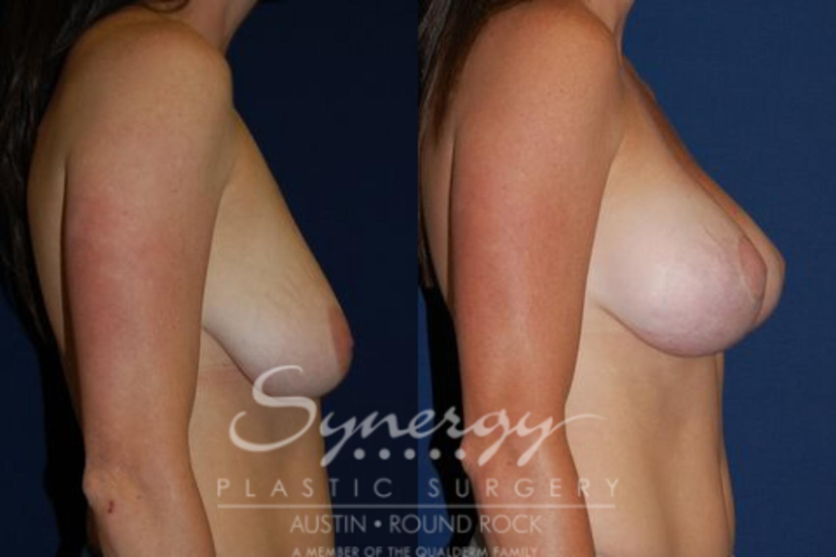 Before & After Breast Lift (Mastopexy) Case 64 View #1 View in Austin, TX