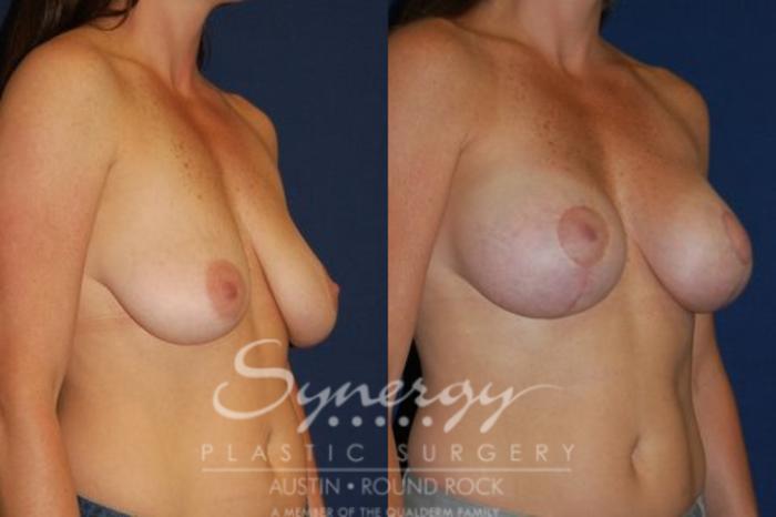 Before & After Breast Lift (Mastopexy) Case 64 View #3 View in Austin, TX