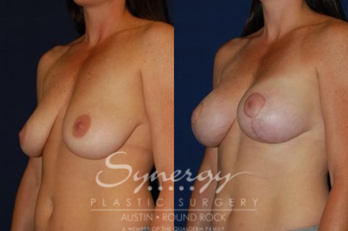 Before & After Breast Lift (Mastopexy) Case 64 View #4 View in Austin, TX