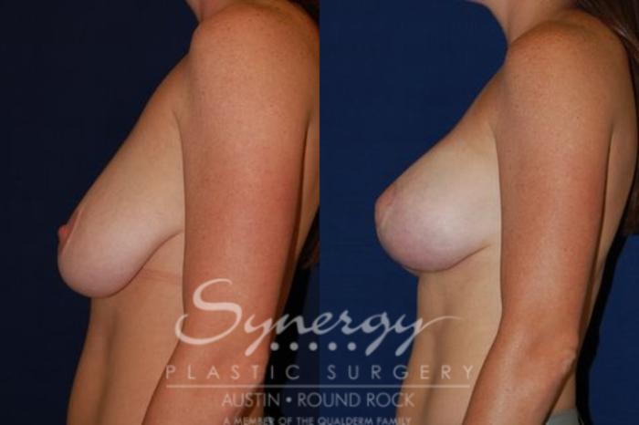 Before & After Breast Lift (Mastopexy) Case 64 View #5 View in Austin, TX