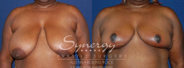 Before & After Breast Reduction Case 88 View #1 View in Austin, TX