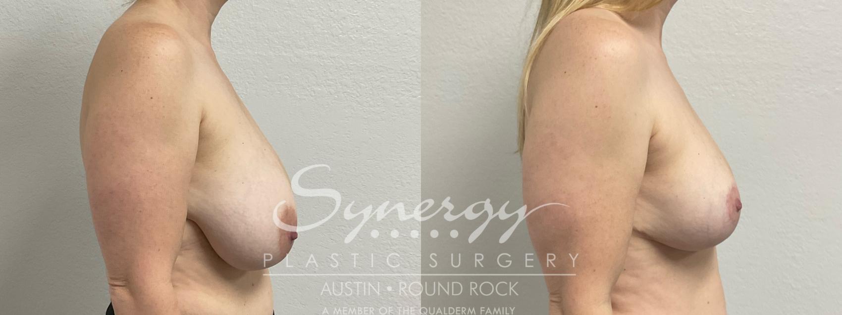 Before & After Breast Reduction Case 948 Right Side View in Austin, TX