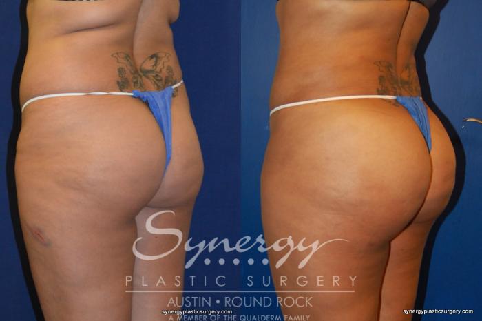 Before & After Buttock Augmentation/Brazilian Butt Lift Case 210 View #1 View in Austin, TX