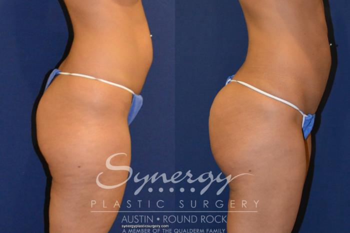 Before & After Buttock Augmentation/Brazilian Butt Lift Case 219 View #1 View in Austin, TX