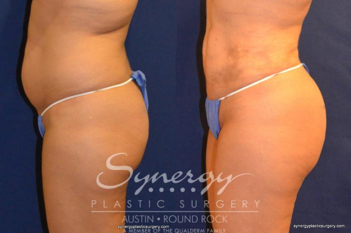 Before & After Buttock Augmentation/Brazilian Butt Lift Case 258 View #2 View in Austin, TX