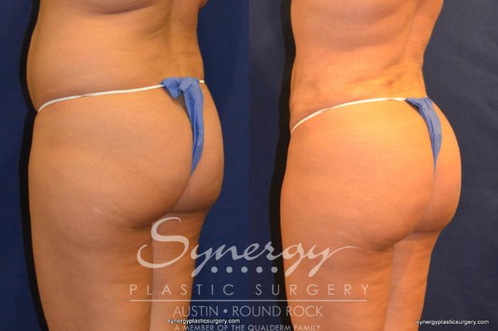 Before & After Buttock Augmentation/Brazilian Butt Lift Case 258 View #3 View in Austin, TX