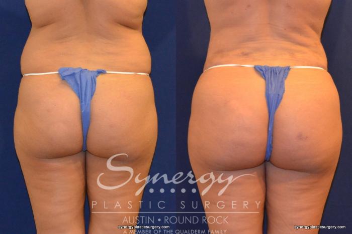 Before & After Buttock Augmentation/Brazilian Butt Lift Case 258 View #4 View in Austin, TX