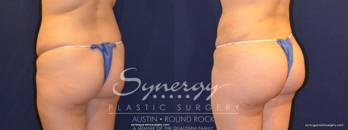 Before & After Buttock Augmentation/Brazilian Butt Lift Case 338 View #1 View in Austin, TX