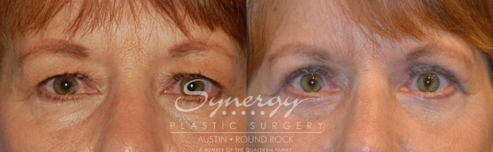 Before & After Eyelid Surgery (Blepharoplasty) Case 309 View #1 View in Austin, TX