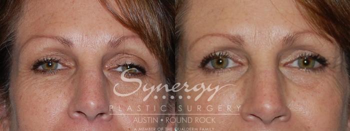 Before & After Eyelid Surgery (Blepharoplasty) Case 87 View #1 View in Austin, TX