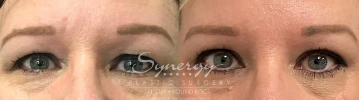 Before & After Eyelid Surgery (Blepharoplasty) Case 874 Front View in Austin, TX