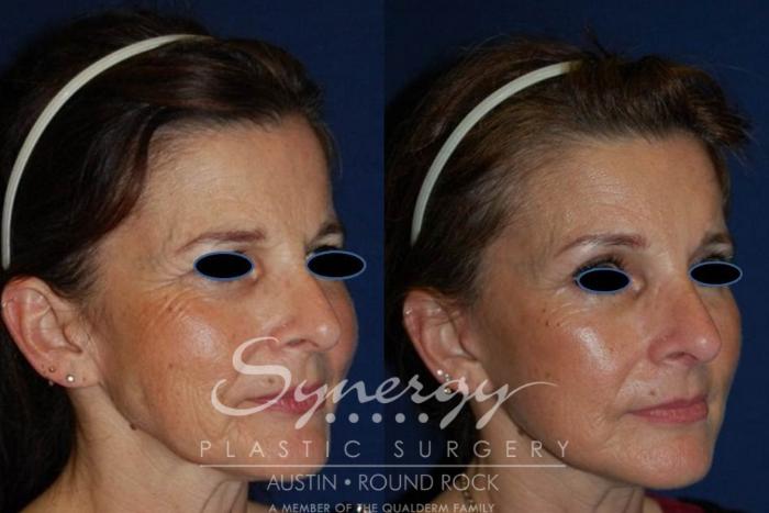Before & After Facelift Case 123 View #1 View in Austin, TX