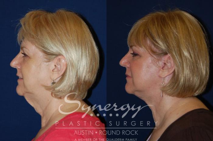 Before & After Facelift Case 128 View #1 View in Austin, TX