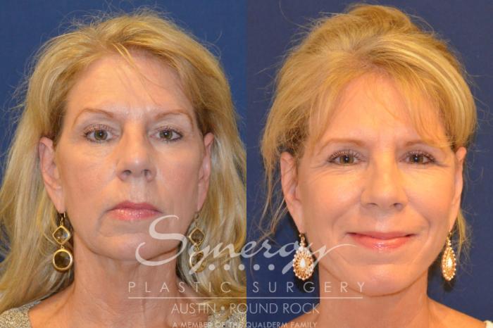 Before & After Facelift Case 296 View #1 View in Austin, TX