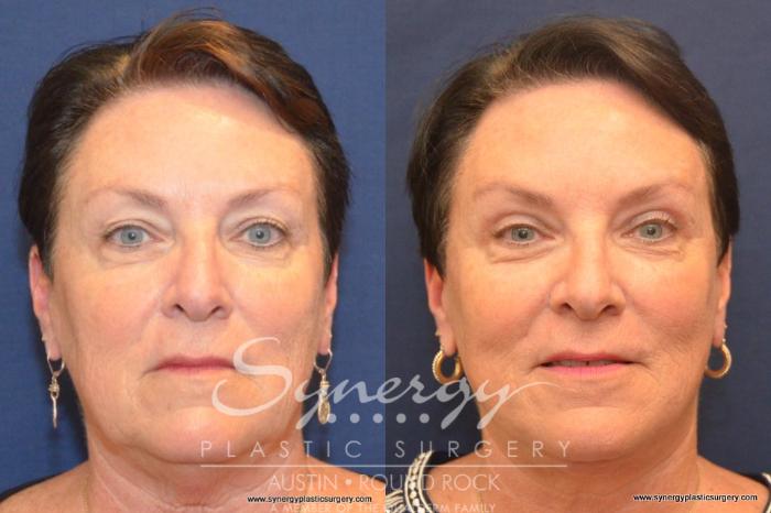 Before & After Facelift Case 406 View #1 View in Austin, TX
