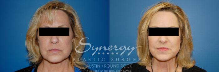 Before & After Facelift Case 9 View #1 View in Austin, TX