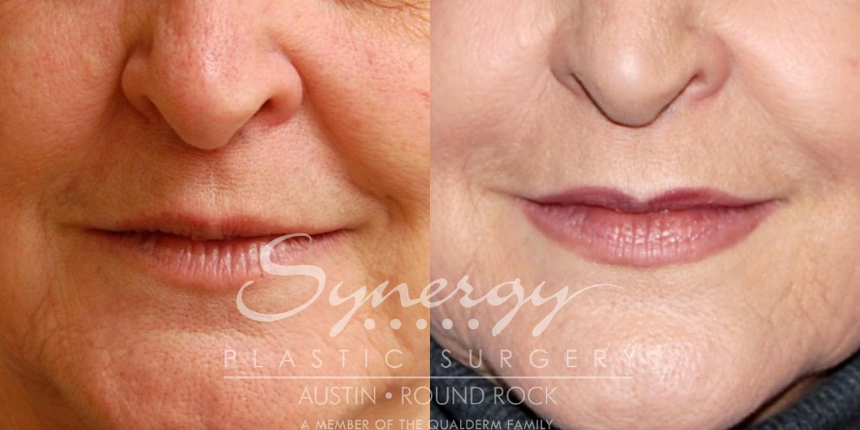 Before & After Injectable Fillers (Wrinkles) Case 20 View #1 View in Austin, TX
