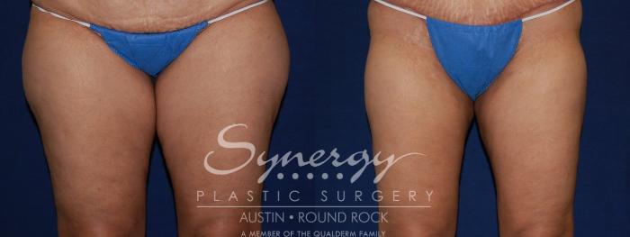 Before & After Liposuction Case 107 View #1 View in Austin, TX