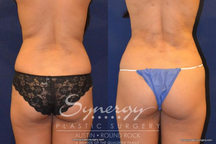 Before & After Liposuction Case 323 View #1 View in Austin, TX