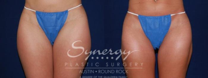 Before & After Liposuction Case 52 View #1 View in Austin, TX