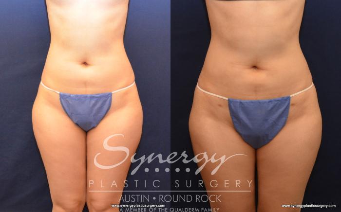 Before & After Liposuction Case 530 View #1 View in Austin, TX