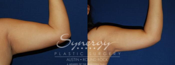 Before & After Liposuction Case 76 View #1 View in Austin, TX